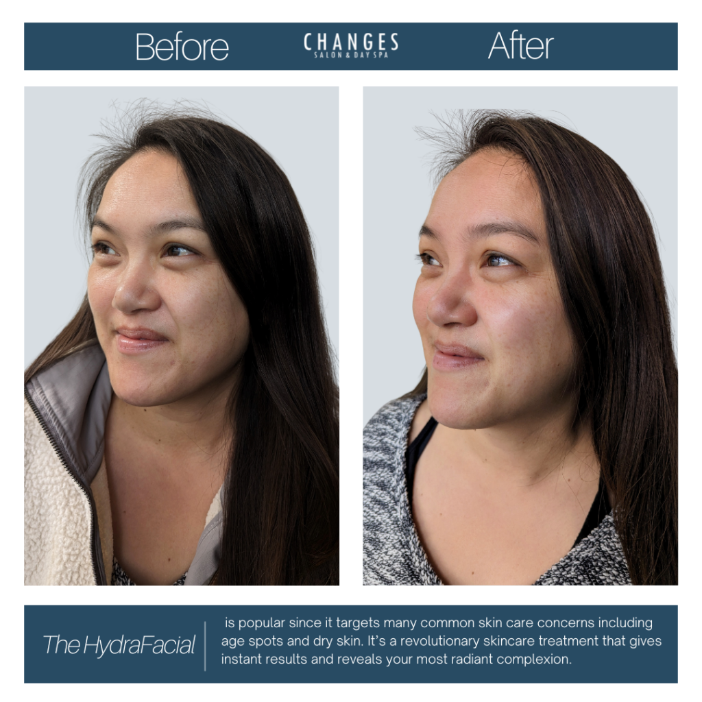 the hydrafacial with bay area buzz influencer before and after treatment photos